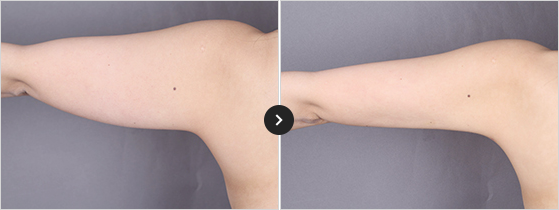 365mc BEFORE & AFTER